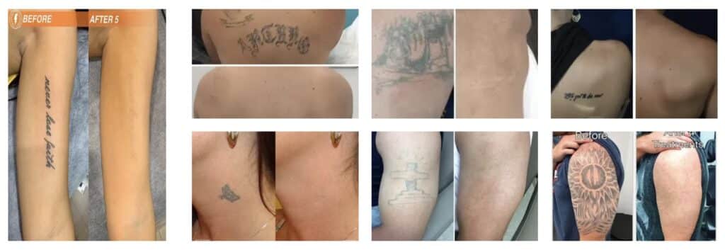 Neatcell Tattoo Removal Pen results