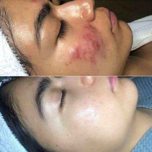 NEATCELL™ High Frequency Facial Wand 7