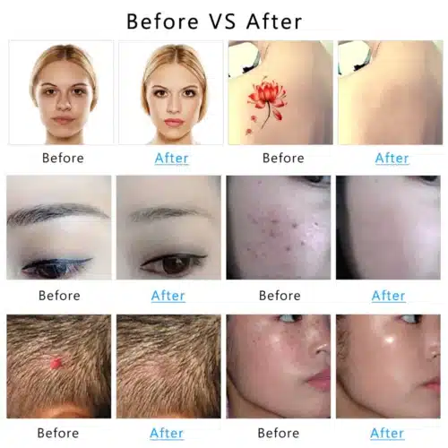 Neatcell Tattoo Removal Pen Benefits